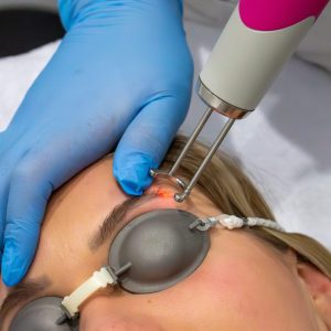 PMU verwijderen met laser in Voorburg/ Den Haag