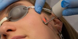 Pigmentvlekken verwijderen met laser bij Sophie Skincare in Voorburg