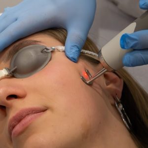 Pigmentvlekken verwijderen met laser bij Sophie Skincare in Voorburg