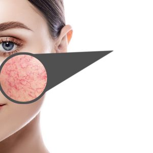 Vaatjes laser behandeling Voiorburg/ Den Haag Sophie Skincare