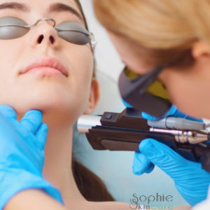 Laser gezicht verminderen rimpels en acne littekens