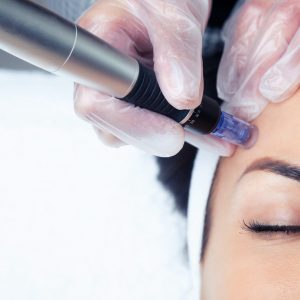 microneedling/ dermapen