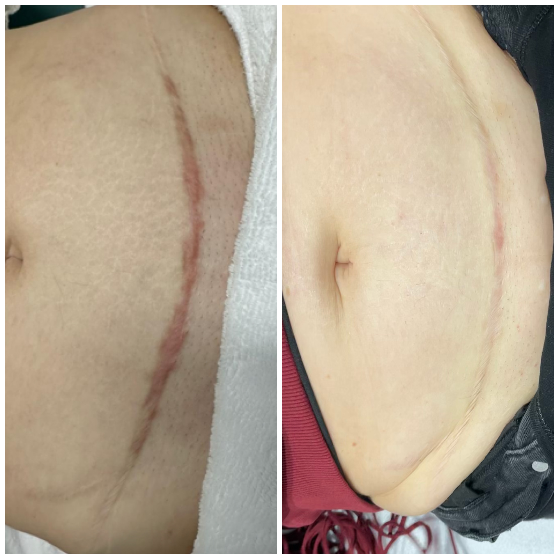 PicoPlasma laserbehandeling resultaat na 1 behandeling – littekenherstel