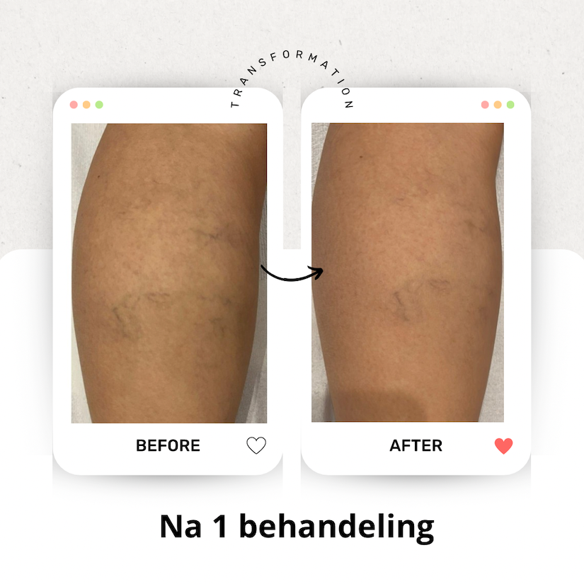 Voor en na vaatlaserbehandeling: zichtbare vaatjes op de kuit na een behandeling